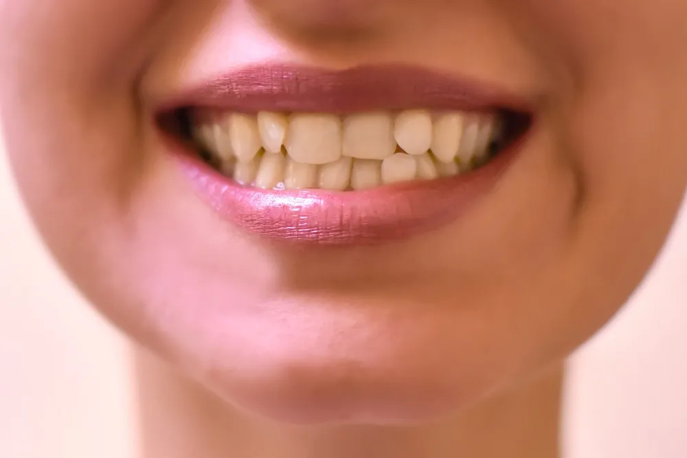 Causes of Crooked Teeth
